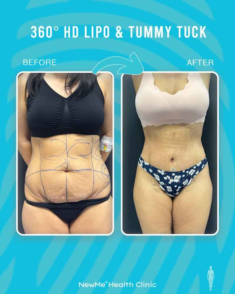 Bahadır 360° Tummy Tuck + Liposuction before and after — NewMe patient