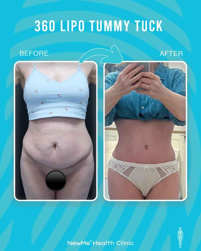 Bahadır 360° Tummy Tuck + Liposuction before and after — NewMe patient