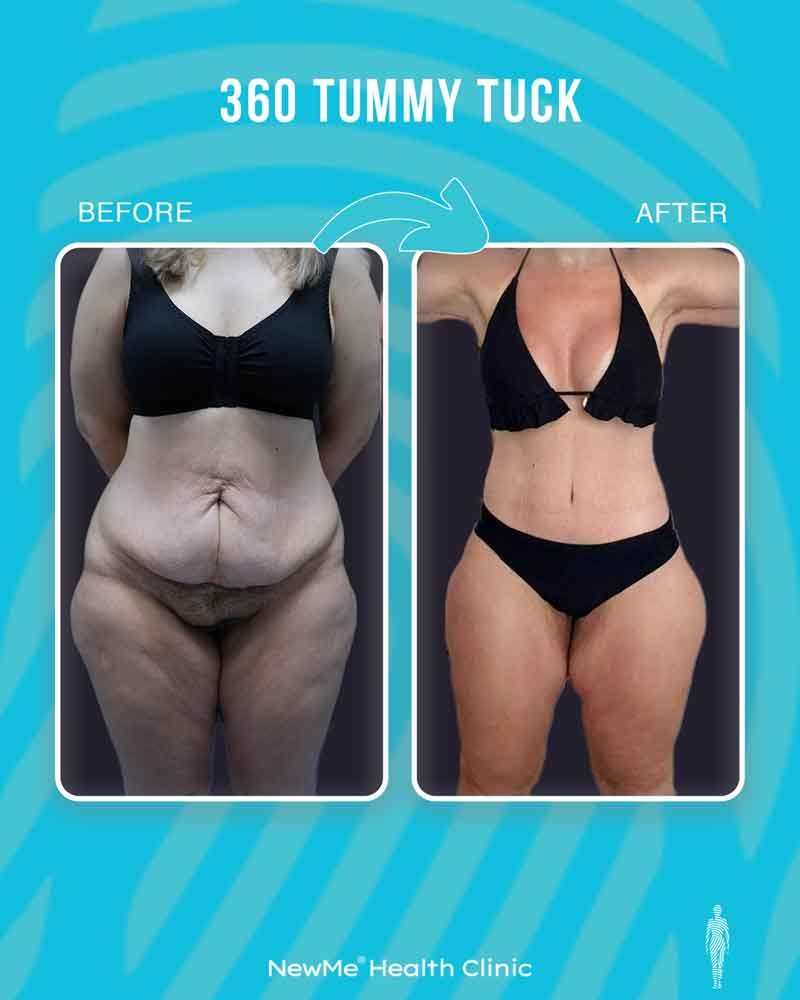 Bahadır 360° Tummy Tuck before and after — NewMe patient
