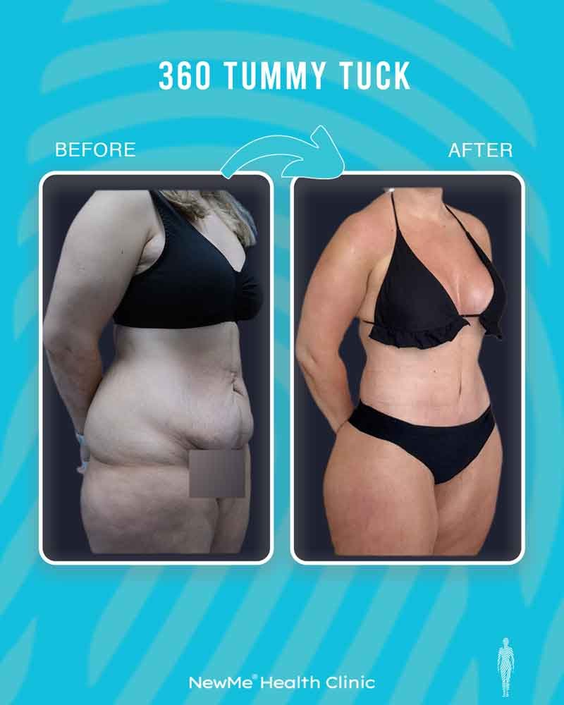 Bahadır 360° Tummy Tuck before and after — NewMe patient