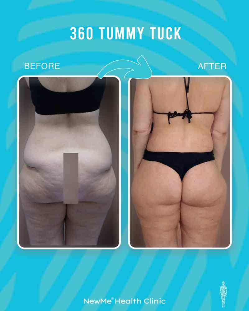 Bahadır 360° Tummy Tuck before and after — NewMe patient