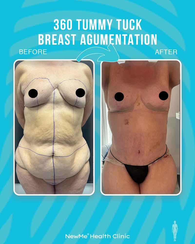Bahadır 360° Tummy Tuck + Breast Augmentation before and after — NewMe patient