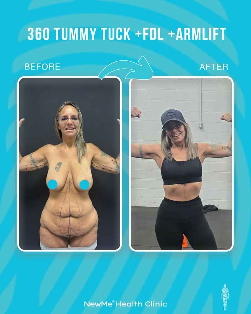Arm lift combination surgery before and after — NewMe patient