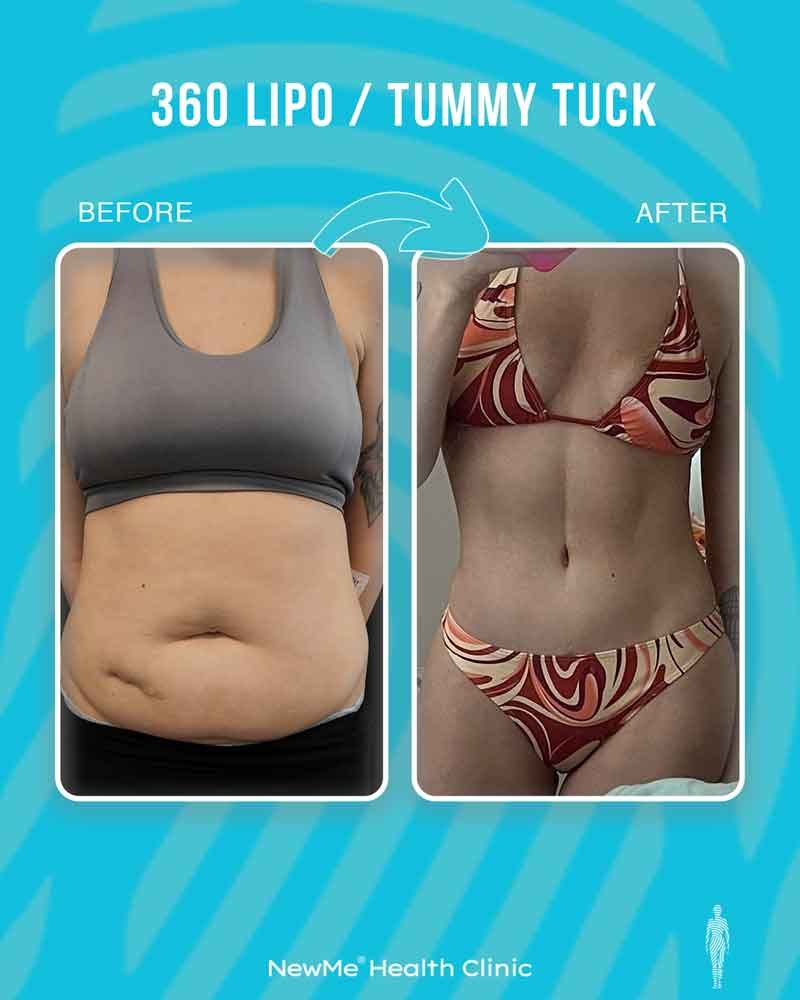 Arm lift combination surgery before and after — NewMe patient