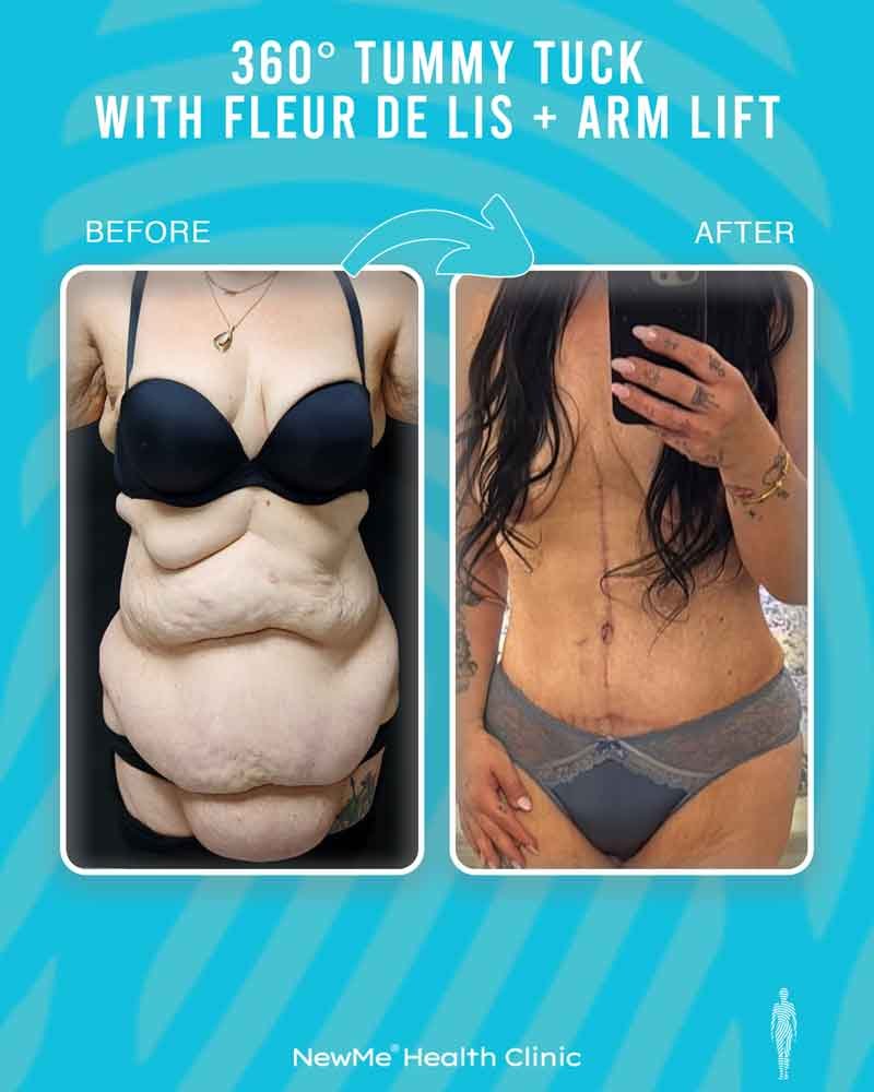 Arm lift combination surgery before and after — NewMe patient