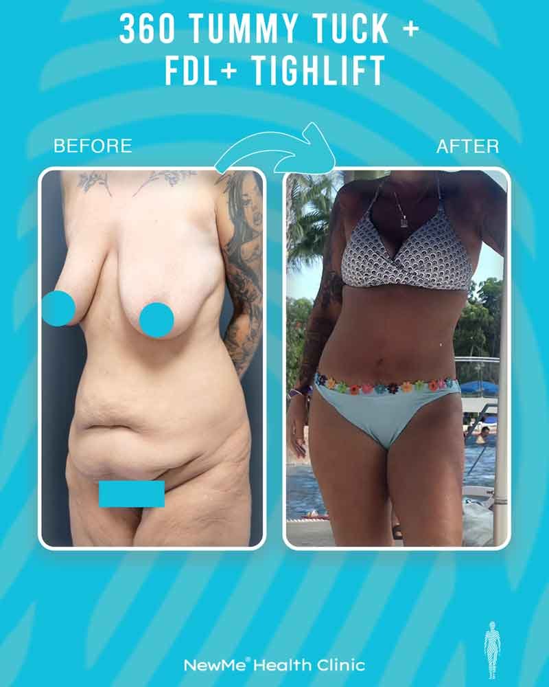 Bahadır 360° Tummy Tuck + Fleur-de-Lis + Thigh Lift before and after — NewMe patient