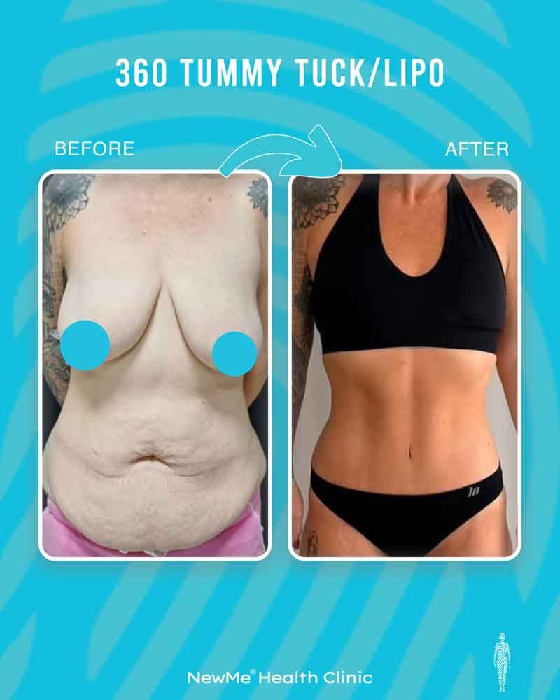 Houtan 360° Tummy Tuck + Liposuction before and after — NewMe patient