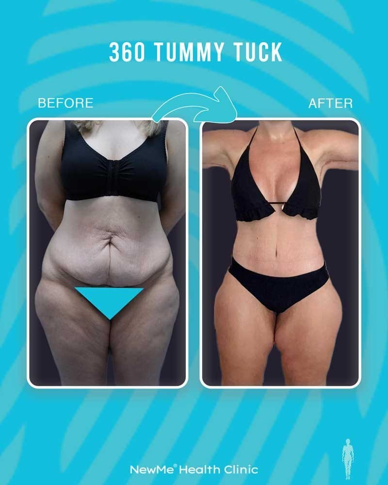 360° tummy tuck before and after — NewMe UK patient