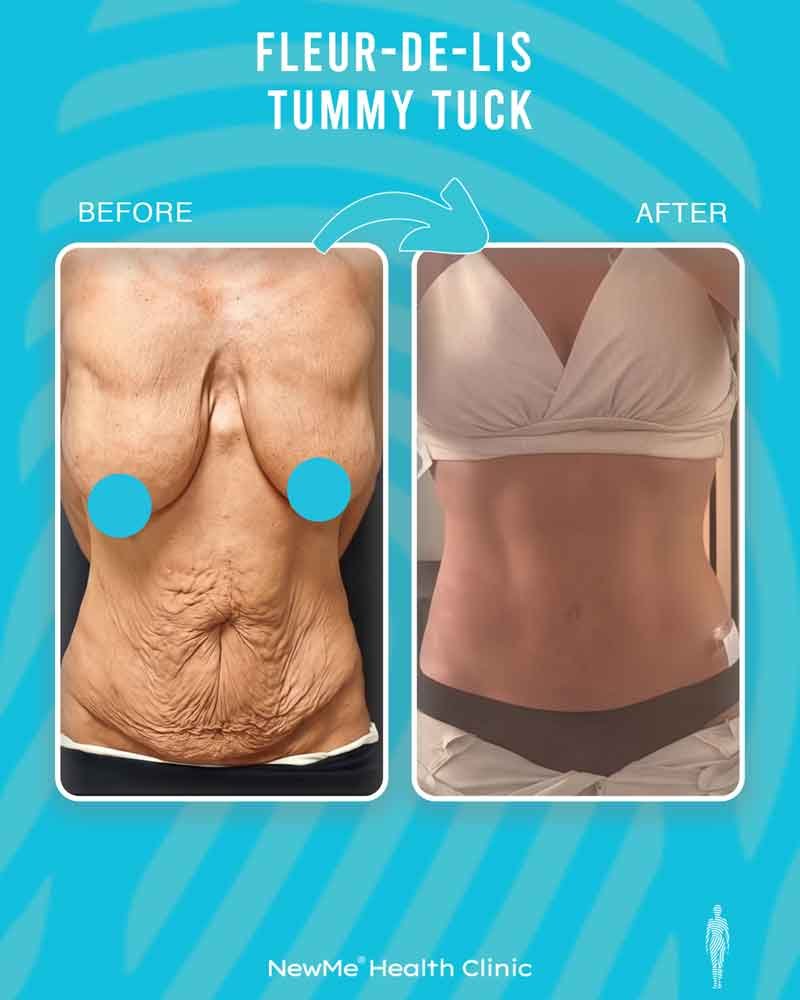 Houtan Tummy Tuck + Fleur-de-Lis before and after — NewMe patient