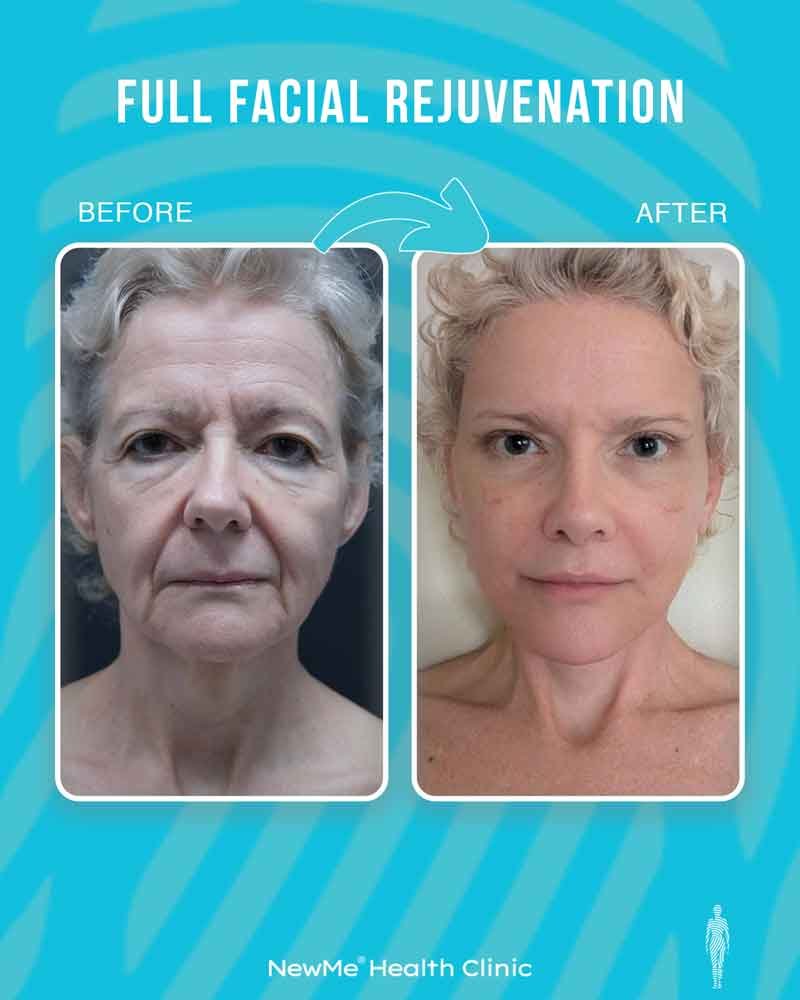 Full facial rejuvenation before and after 1 by Dr. Bahadır — NewMe patient