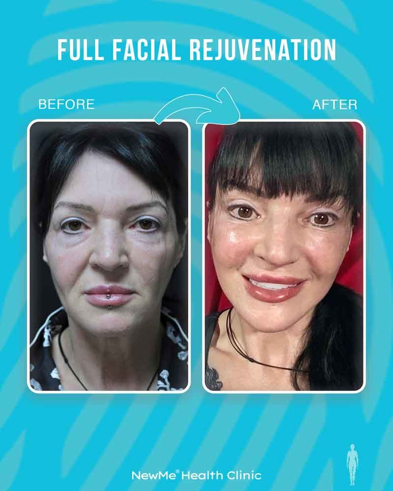 Full facial rejuvenation before and after 10 by Dr. Bahadır — NewMe patient