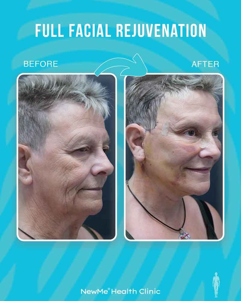 Full facial rejuvenation before and after 11 by Dr. Bahadır — NewMe patient