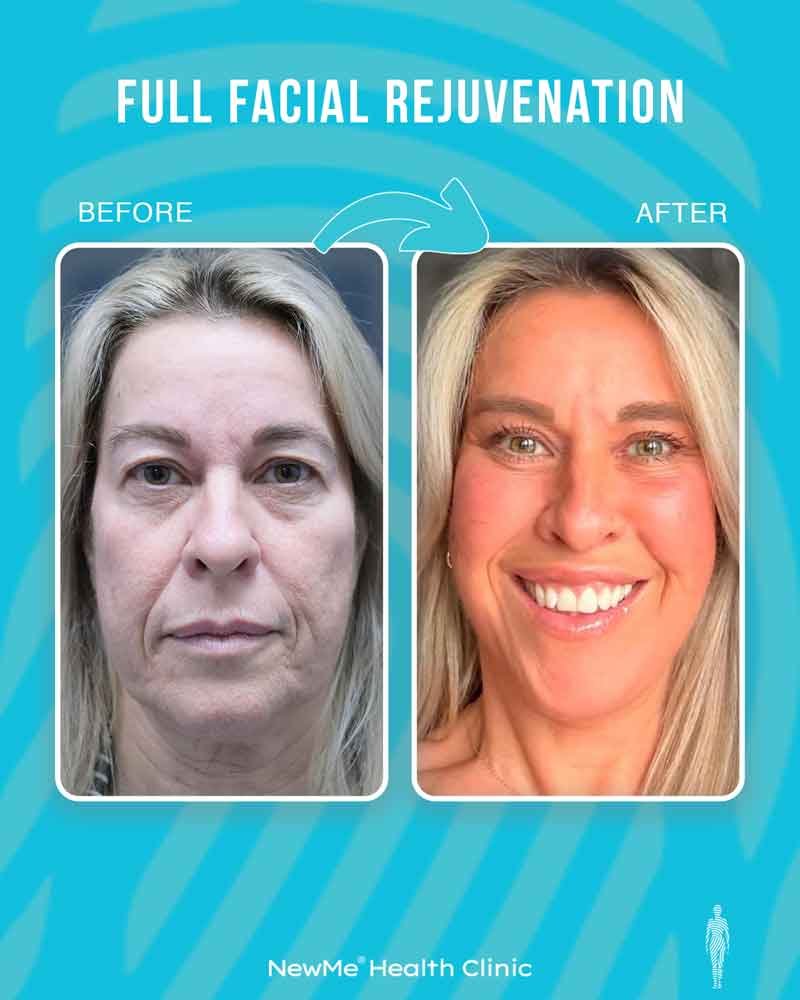 Full facial rejuvenation before and after 12 by Dr. Bahadır — NewMe patient