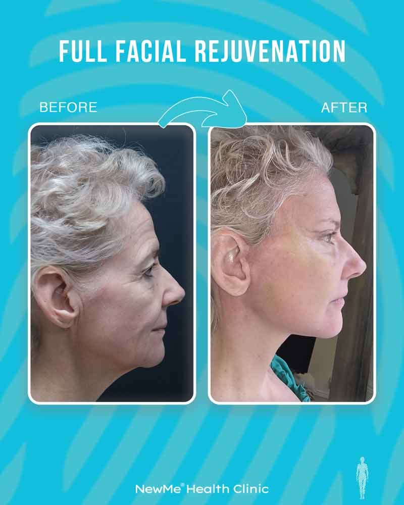 Full facial rejuvenation before and after 13 by Dr. Bahadır — NewMe patient
