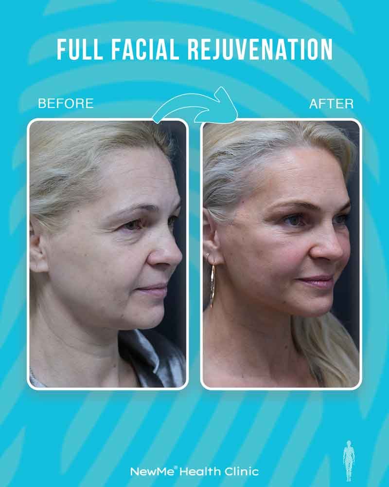 Full facial rejuvenation before and after 14 by Dr. Bahadır — NewMe patient