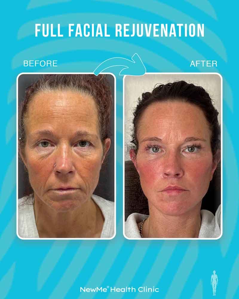 Full facial rejuvenation before and after 2 by Dr. Bahadır — NewMe patient