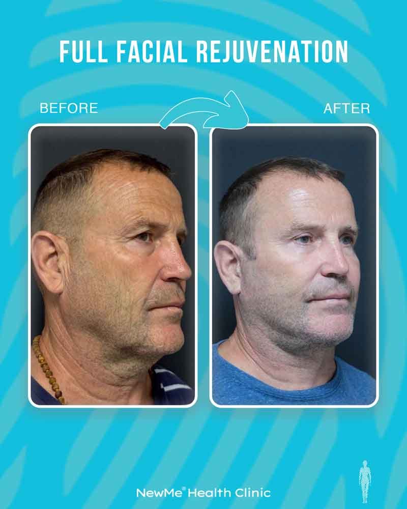 Full facial rejuvenation before and after 3 by Dr. Bahadır — NewMe patient