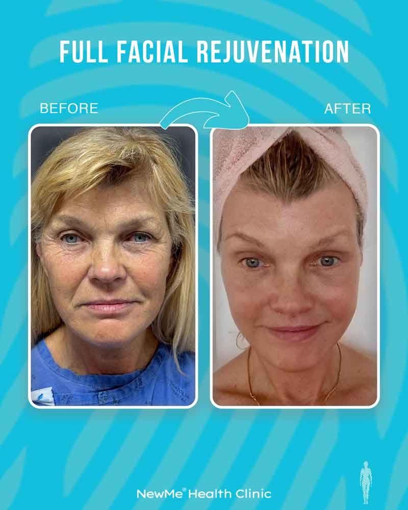 Full facial rejuvenation before and after 4 by Dr. Bahadır — NewMe patient