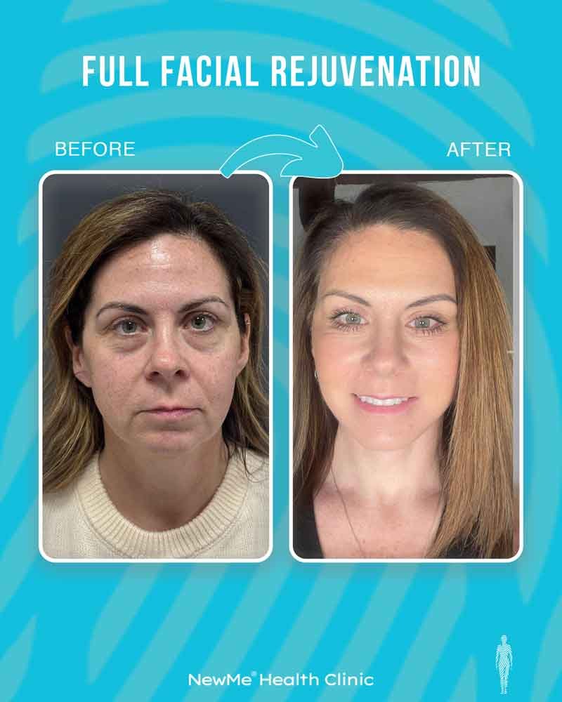 Full facial rejuvenation before and after 5 by Dr. Bahadır — NewMe patient