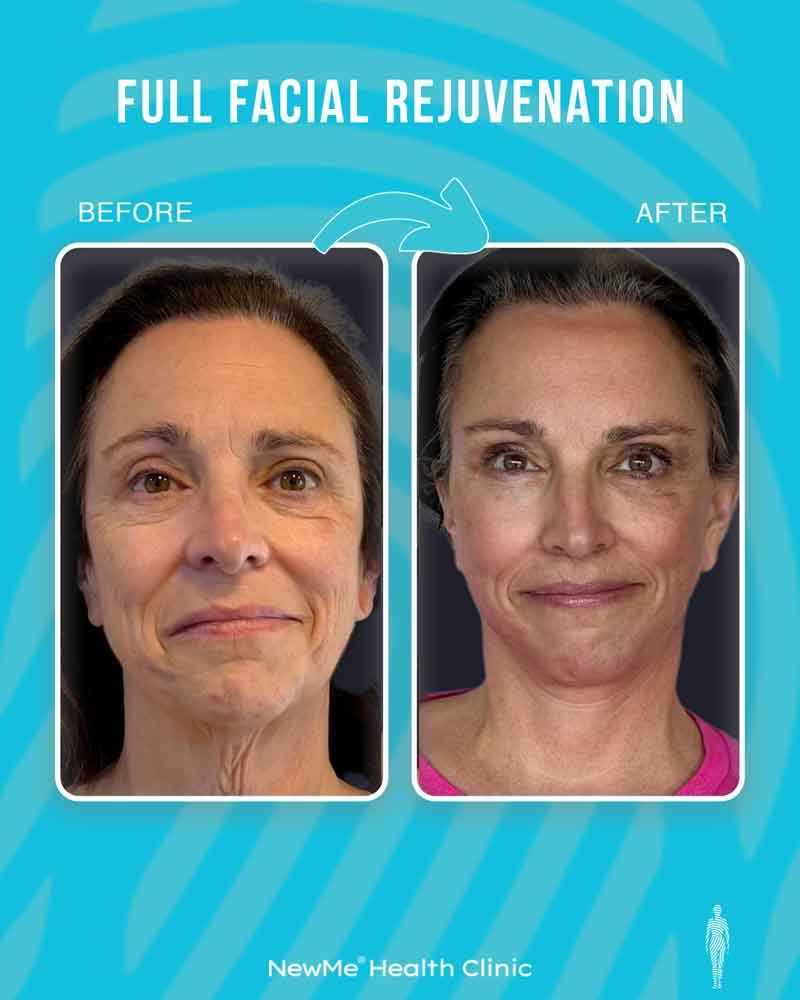 Full facial rejuvenation before and after 6 by Dr. Bahadır — NewMe patient