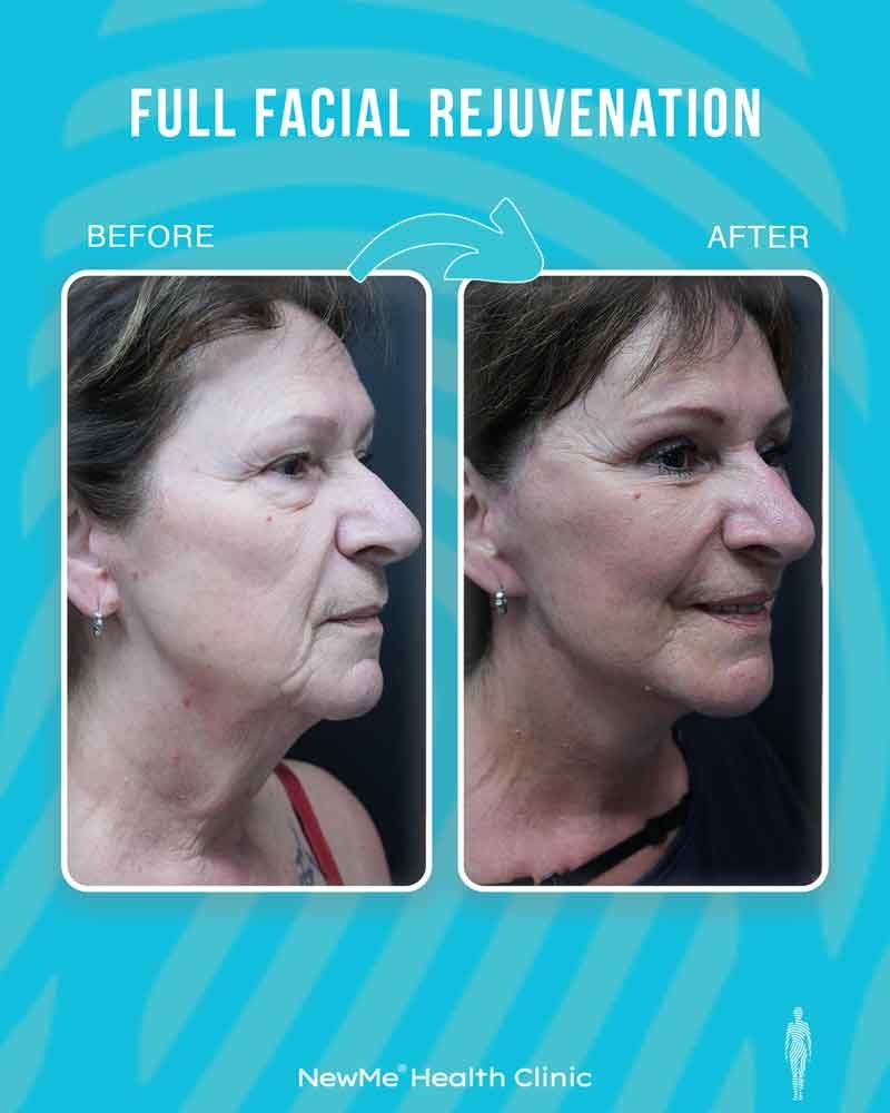 Full facial rejuvenation before and after 7 by Dr. Bahadır — NewMe patient