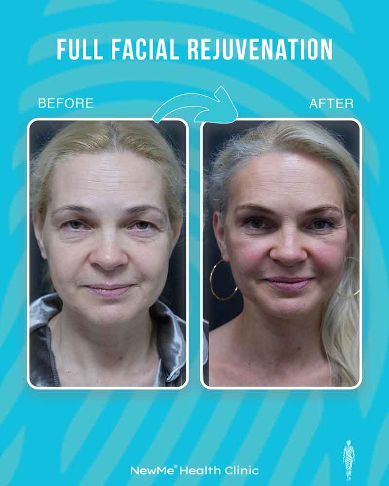Facial rejuvenation before and after — NewMe UK patient