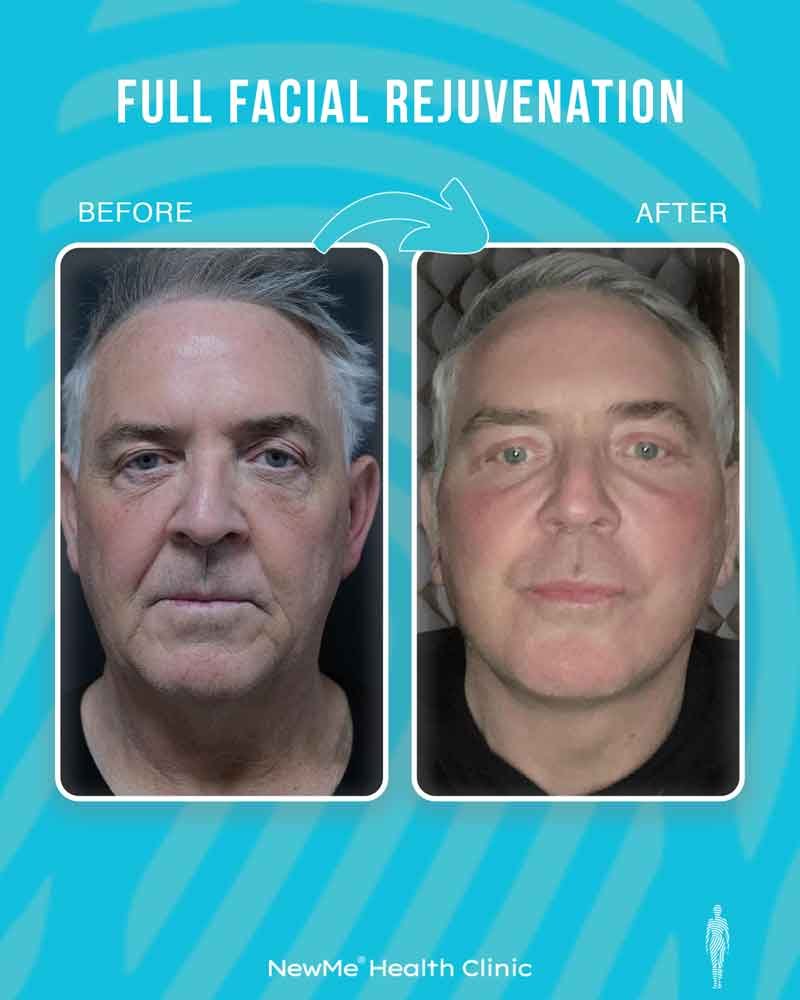 Full facial rejuvenation before and after 9 by Dr. Bahadır — NewMe patient