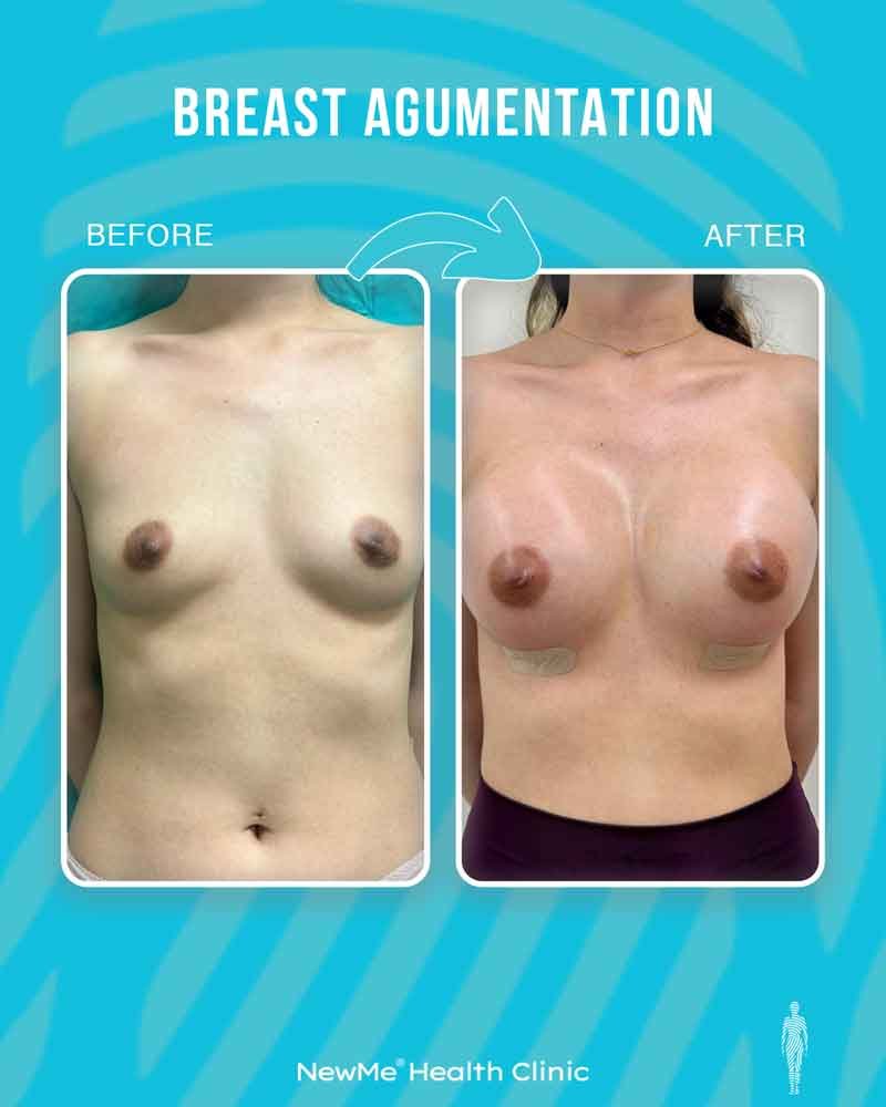 Breast surgery before and after — NewMe patient