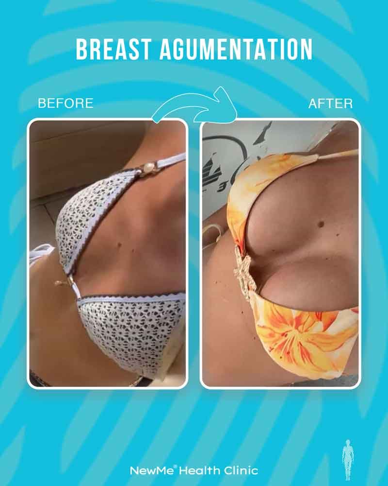 Breast surgery before and after — NewMe patient