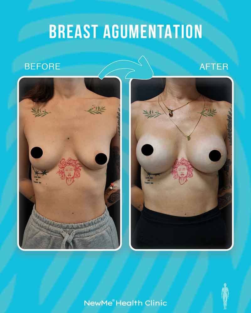 Breast surgery before and after — NewMe patient