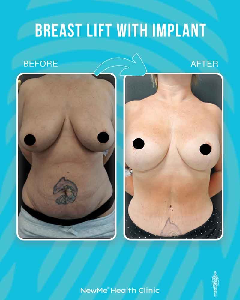 Breast surgery before and after — NewMe patient