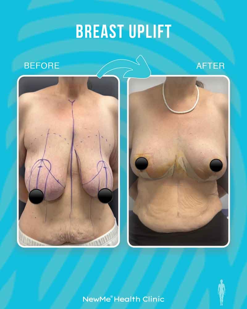 Breast surgery before and after — NewMe patient