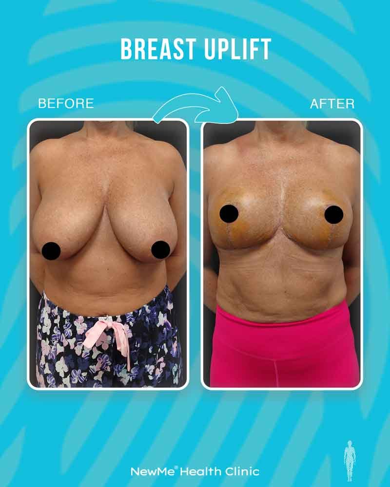 Breast surgery before and after — NewMe patient
