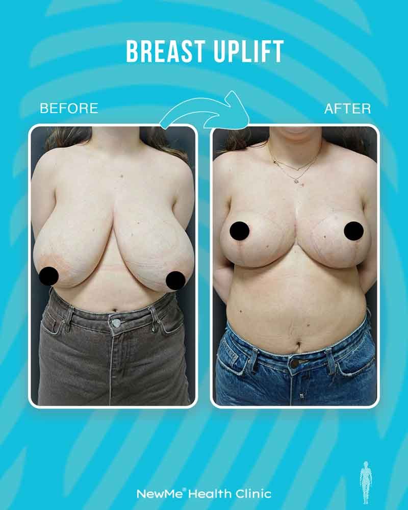 Breast surgery before and after — NewMe patient