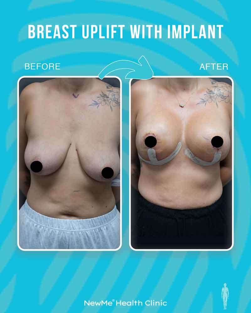 Breast surgery before and after — NewMe patient