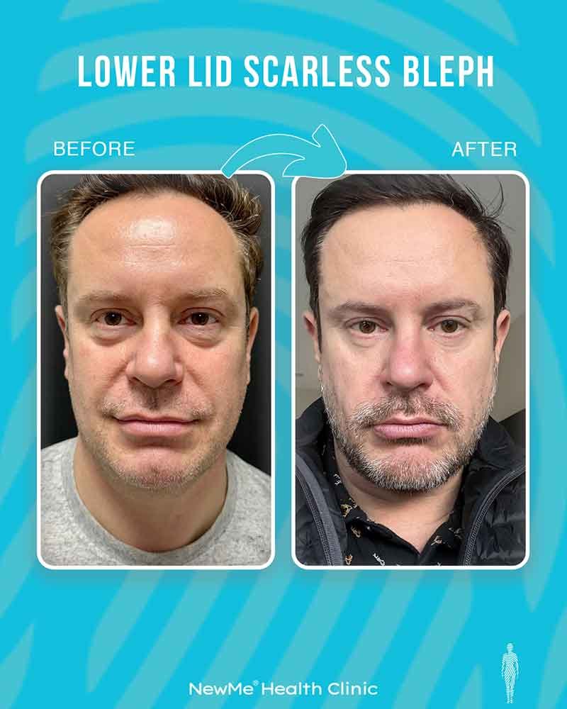 Hair transplant before and after — Dr. Okan Tanın, NewMe patient