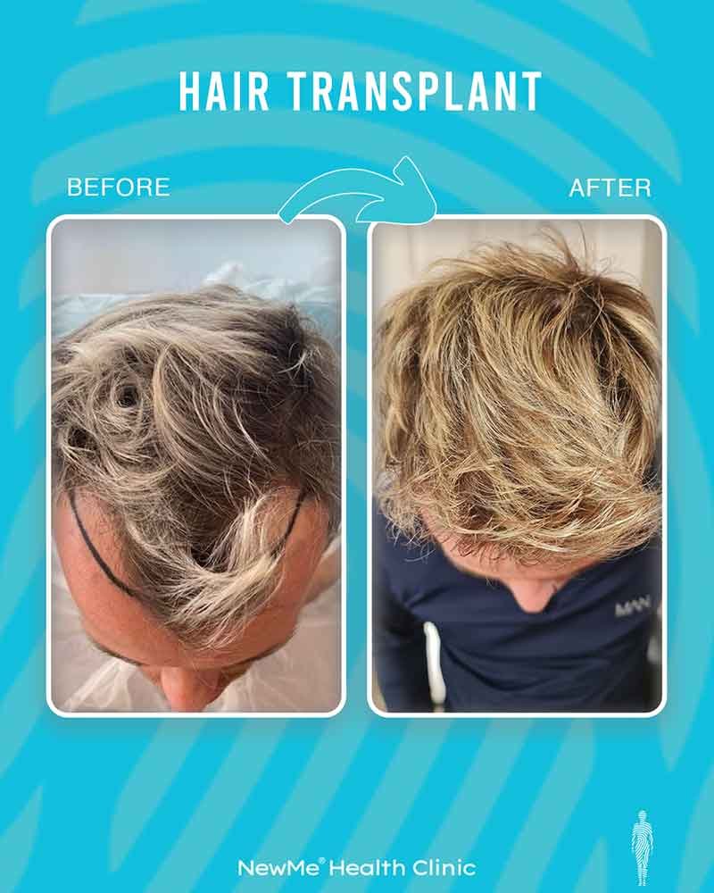 Hair transplant before and after — Dr. Okan Tanın, NewMe patient