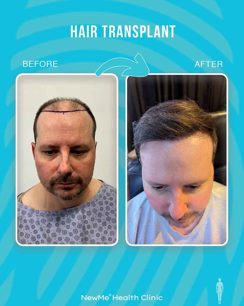 Hair transplant before and after — Dr. Okan Tanın, NewMe patient