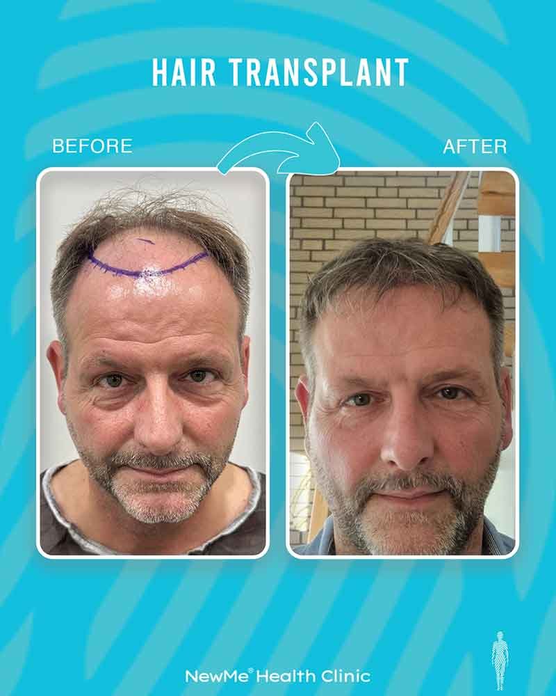 Hair transplant before and after — Dr. Okan Tanın, NewMe patient