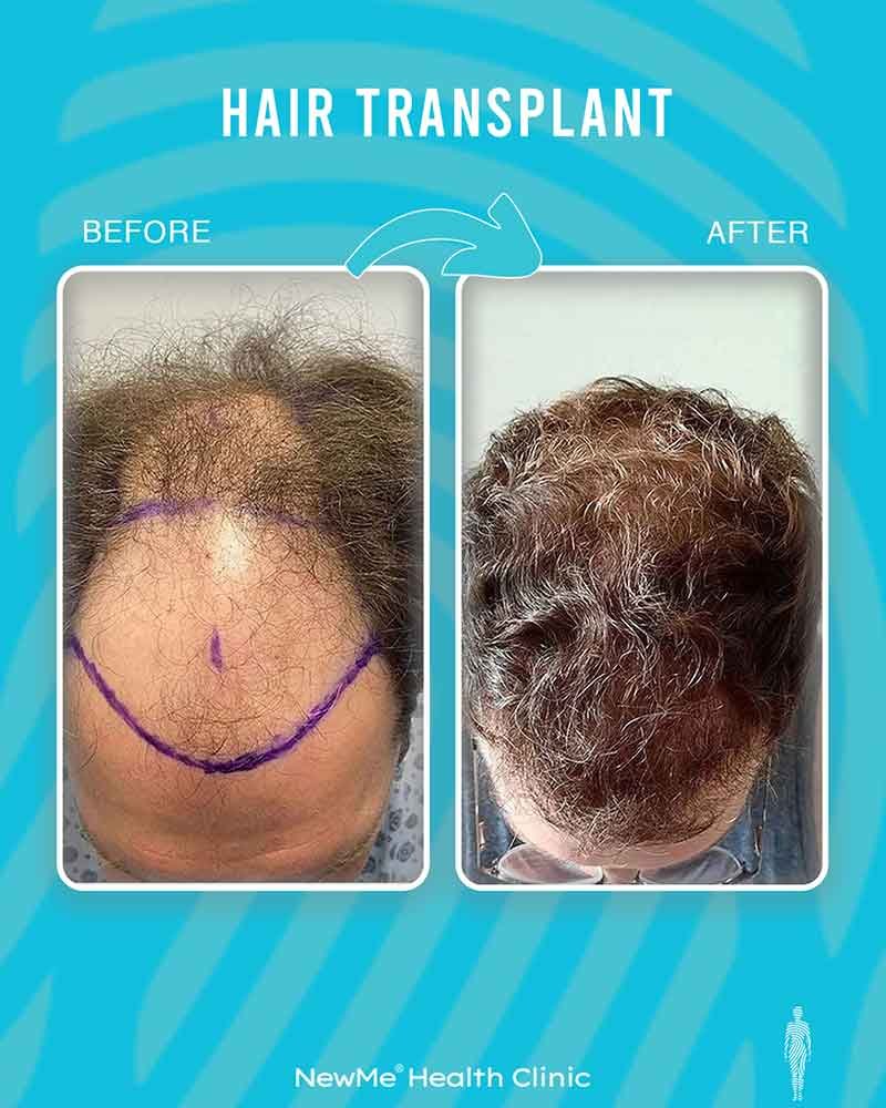 Hair transplant before and after — Dr. Okan Tanın, NewMe patient