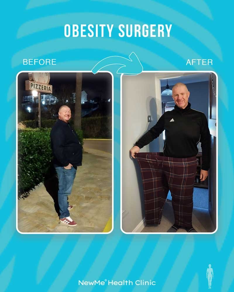 Weight loss surgery before and after — NewMe UK patient