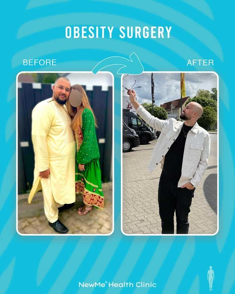 Obesity surgery before and after — NewMe patient