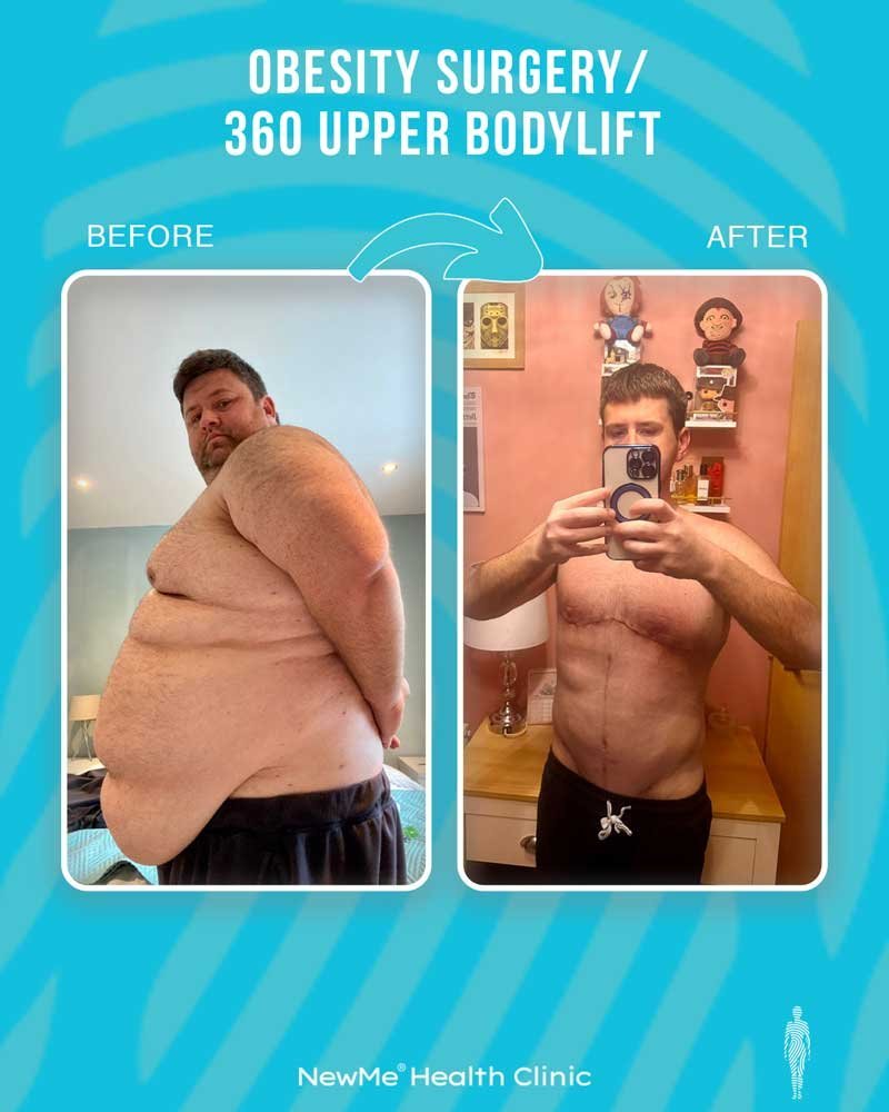 Weight loss surgery before and after — NewMe Health Clinic patient