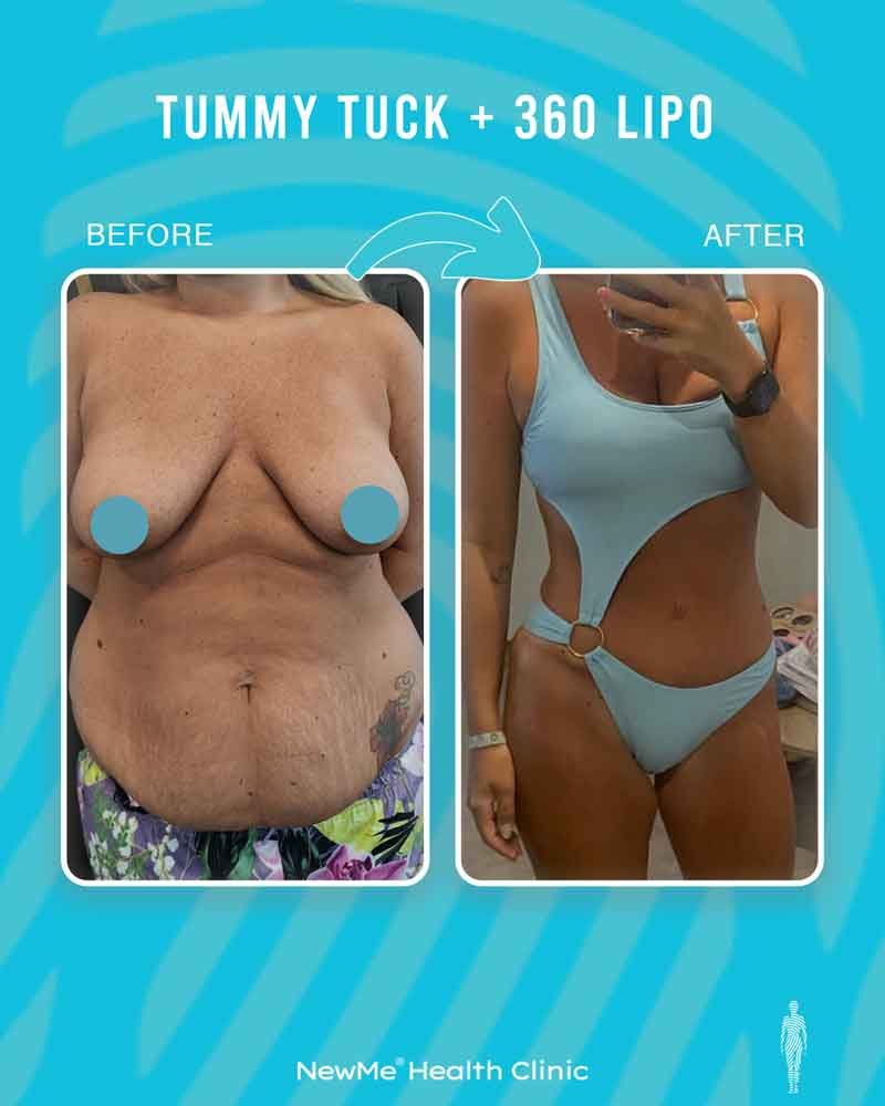 Houtan 360° Tummy Tuck + Liposuction before and after — NewMe patient