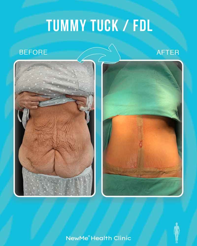 Houtan Tummy Tuck + Fleur-de-Lis before and after — NewMe patient