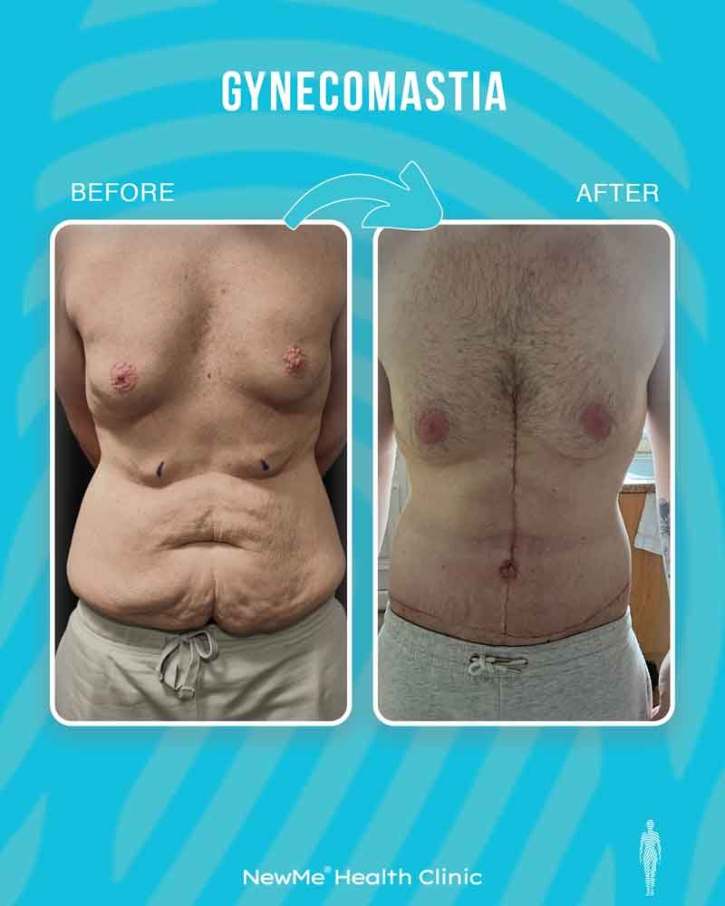 Gynecomastia before and after — Dr. Houtan, NewMe patient