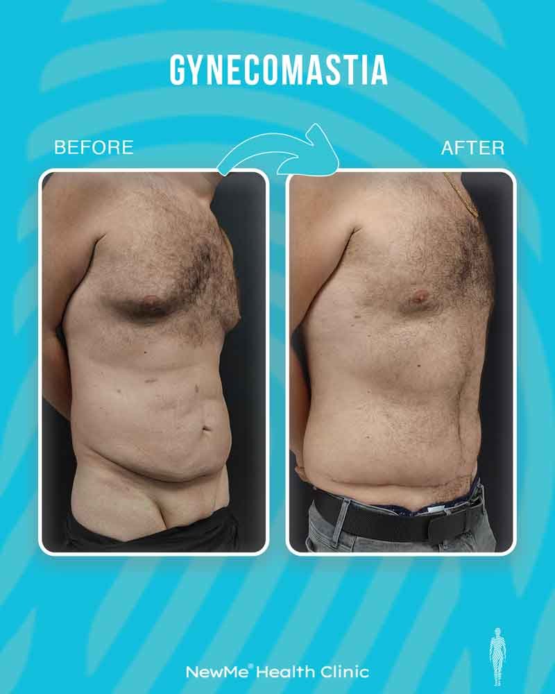 Gynecomastia before and after — Dr. Houtan, NewMe patient