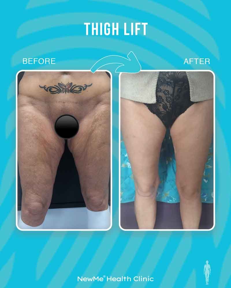 Thigh lift before and after — Dr. Bahadır, NewMe patient