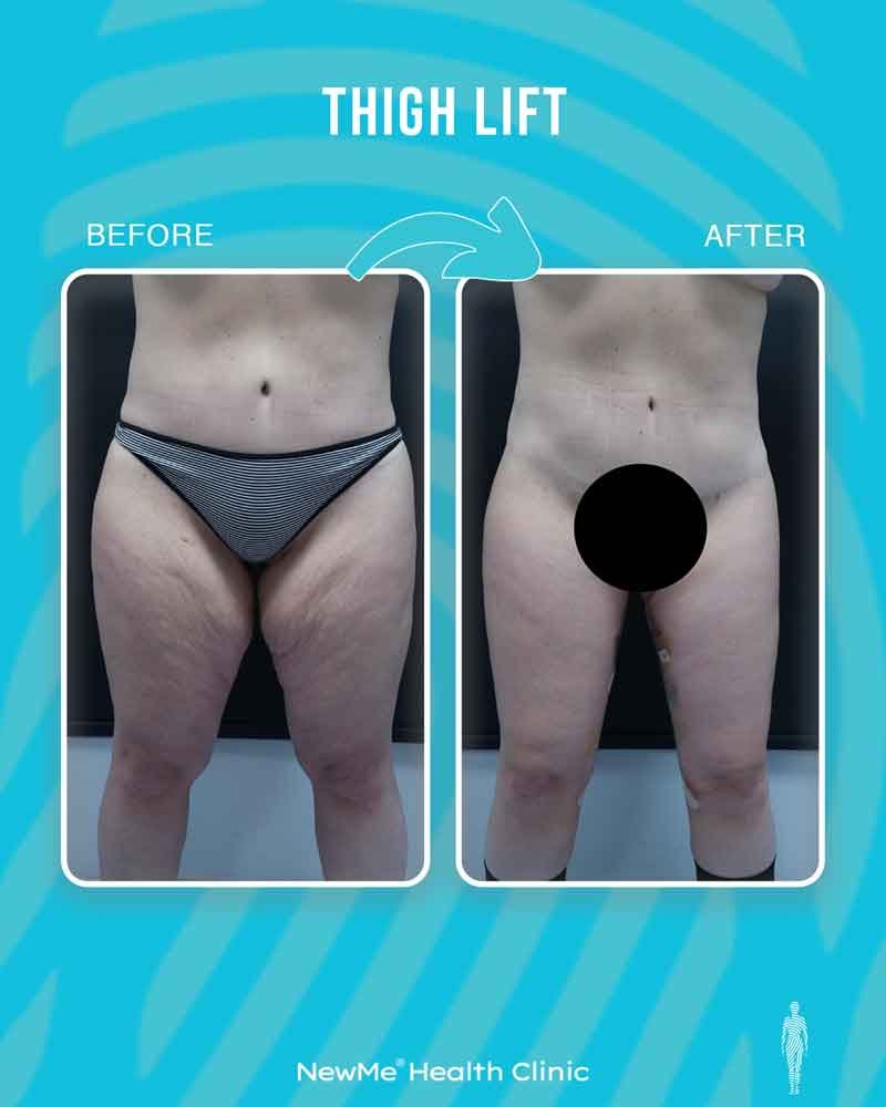 Thigh lift before and after — Dr. Bahadır, NewMe patient
