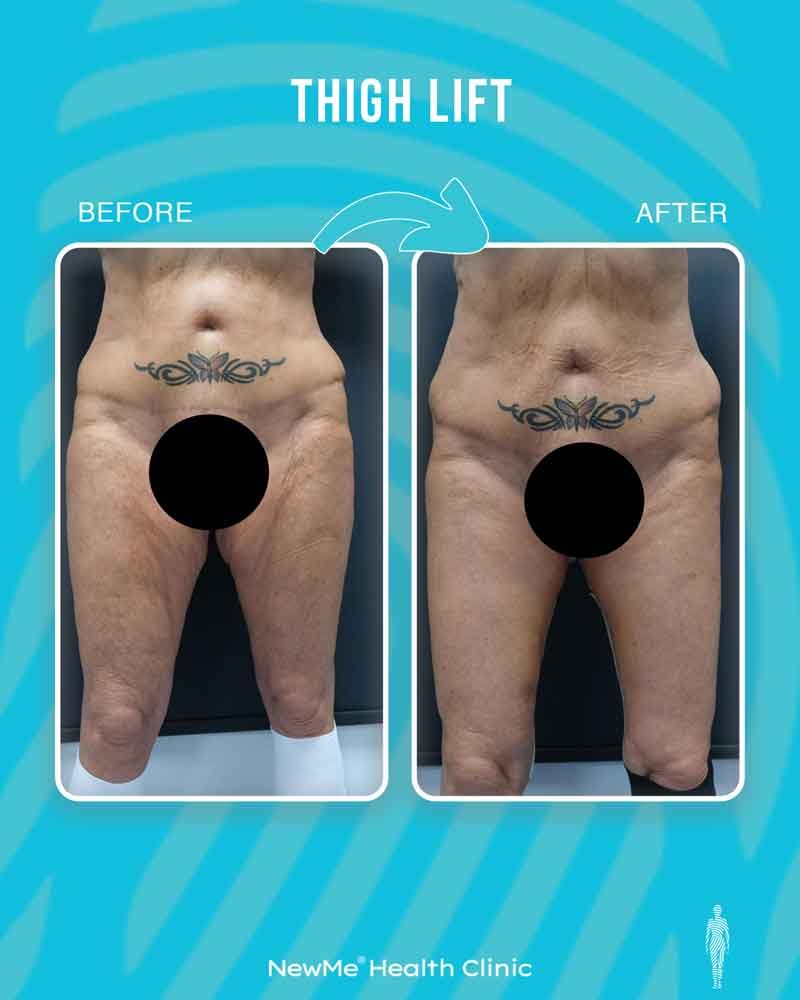 Thigh lift before and after — Dr. Bahadır, NewMe patient